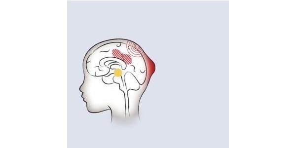 如何用紗布繃帶處理頭皮血腫