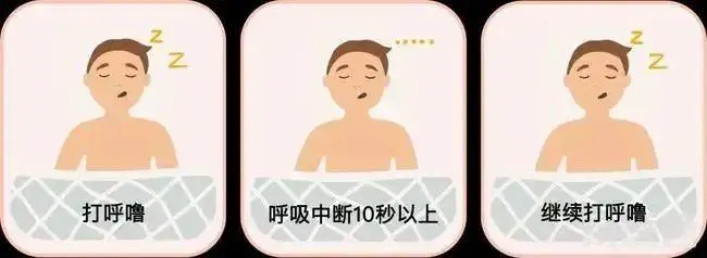 睡眠呼吸暫停綜合征
