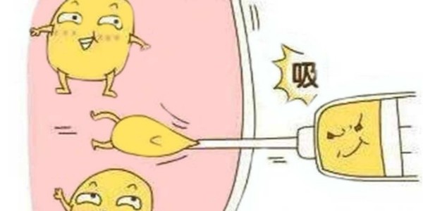 注射器吸脂術(shù)是什么