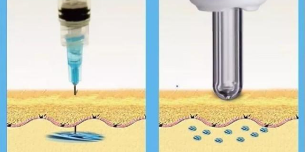 胰島素泵和無針注射器有什么區(qū)別