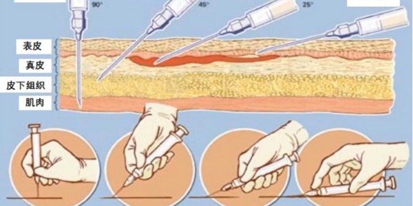 用注射器打針時(shí)傷神經(jīng)怎么辦